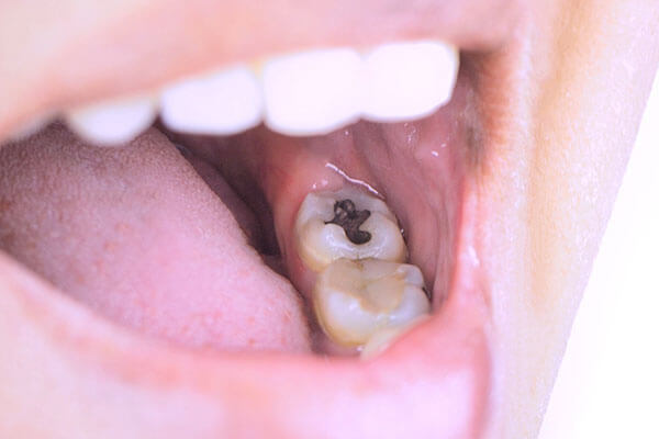 Amalgam ab 2025 nicht mehr erlaubt