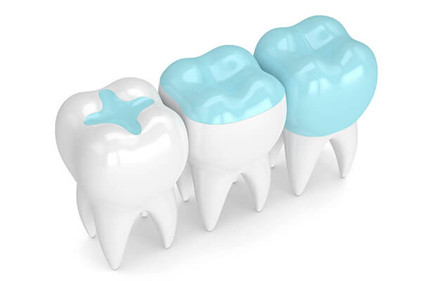 Füllungstherapie & Inlaytechnik